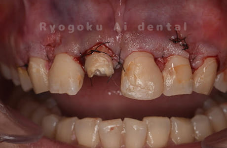 クラウンレングスニング