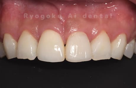 APF、ダイレクトボンディング、セラミック補綴、ホワイトニング