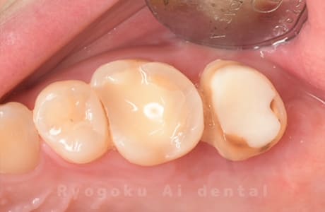 クラウンレングスニング