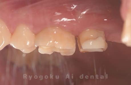 クラウンレングスニング