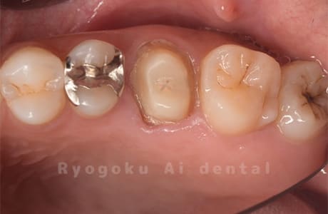 セラミッククラウン脱離、重度カリエス