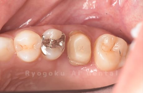 クラウンレングスニング