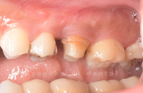 クラウンレングスニング