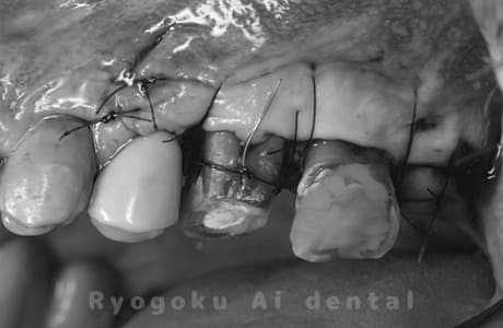 クラウンレングスニング術中