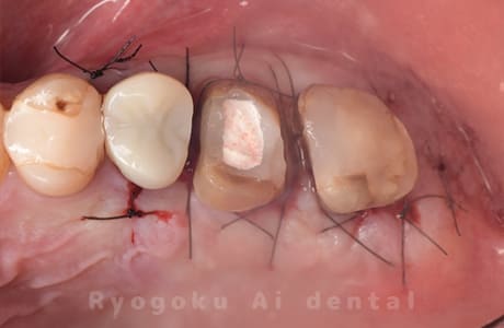 クラウンレングスニング