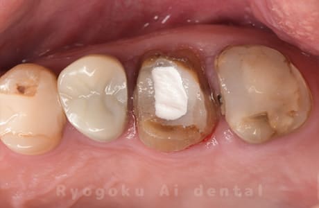 クラウンレングスニング