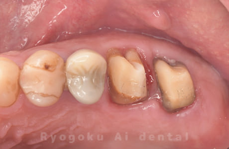 クラウンレングスニング