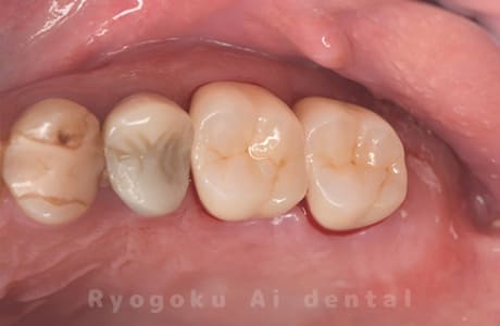 ジルコニアクラウン修復