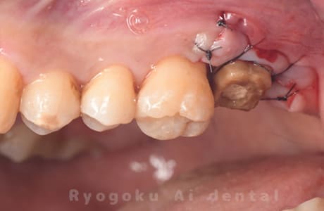 クラウンレングスニング術中