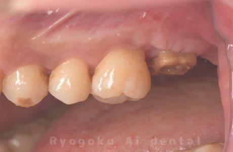 クラウンレングスニングの術後