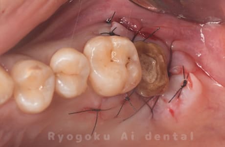 クラウンレングスニング