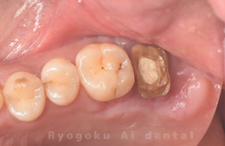 クラウンレングスニング