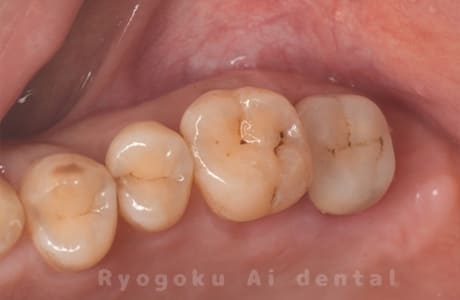 ジルコニアクラウン修復