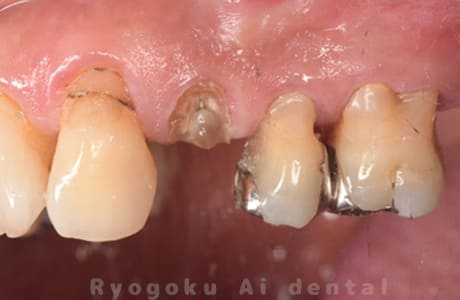 部分矯正 クラウンレングスニング 正面術前