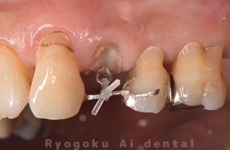 部分矯正 クラウンレングスニング 正面術中