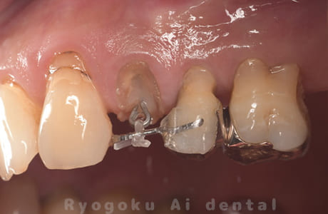 部分矯正 クラウンレングスニング 正面術中