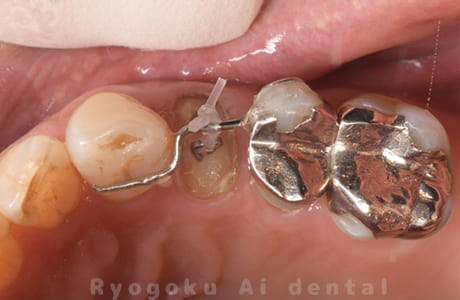 部分矯正 クラウンレングスニング 咬合面術前