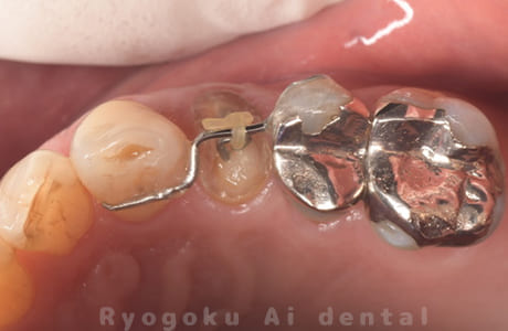 部分矯正 クラウンレングスニング 咬合面術後