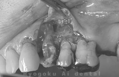 歯根端切除術中