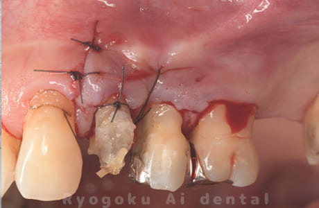 歯根端切除術直後