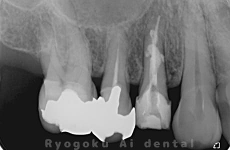 マイクロエンド術後