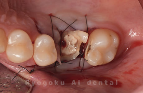 クラウンレングスニング術中