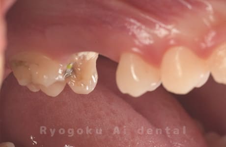 クラウンレングスニング術前