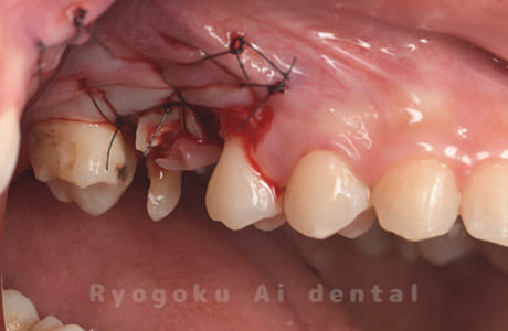 クラウンレングスニング術中