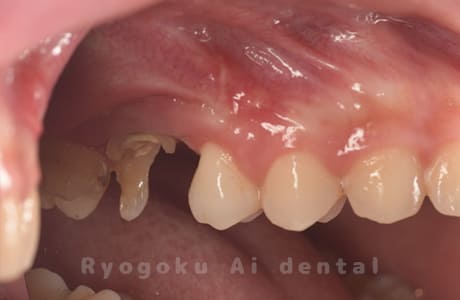 クラウンレングスニング術後