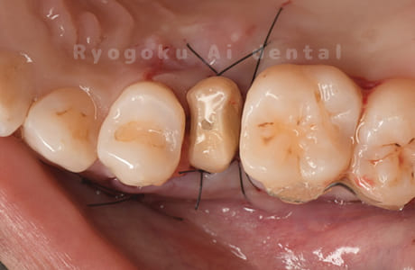 クラウンレングスニング術中