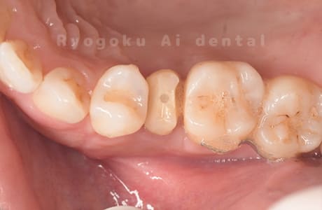 クラウンレングスニング術後