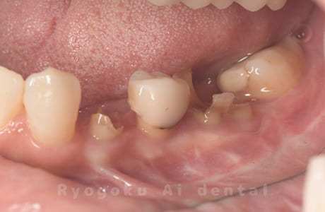 クラウンレングスニング