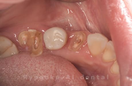 クラウンレングスニング