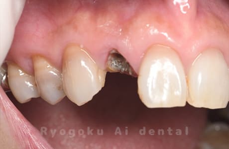 クラウンレングスニング術前１