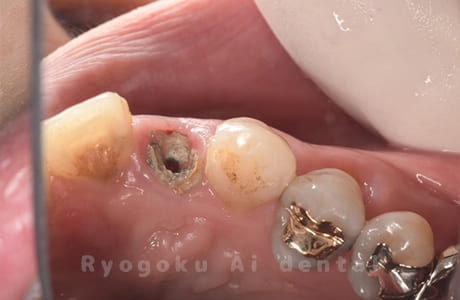 クラウンレングスニング術前２