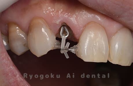 クラウンレングスニング術後