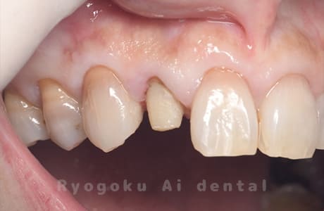 クラウンレングスニング術中１