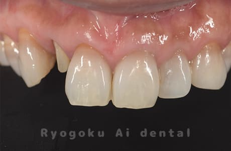 クラウンレングスニング術中２