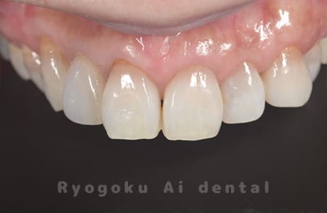 クラウンレングスニング術後