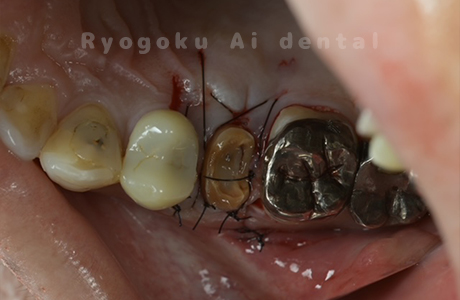 クラウンレングスニング術後