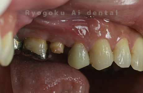 クラウンレングスニング術前２