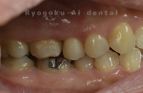 クラウンレングスニング術後