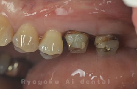 クラウンレングスニング術後