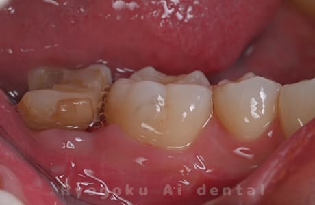 クラウンレングスニング治療