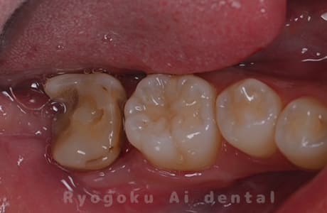 クラウンレングスニング治療