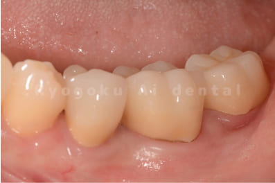 被せ物の型取りを行い、終了