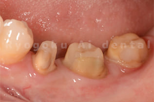 クラウンレングスニングの終了