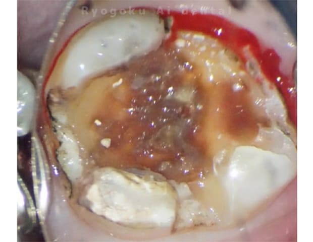 マイクロスコープで虫歯を徹底的に除去します