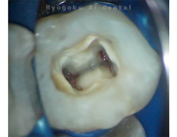 マイクロスコープで感染している神経を除去し、洗浄・消毒