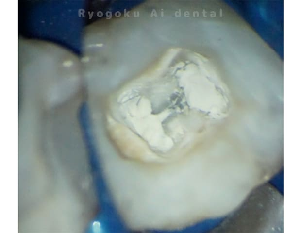 MTA（薬）を置きます